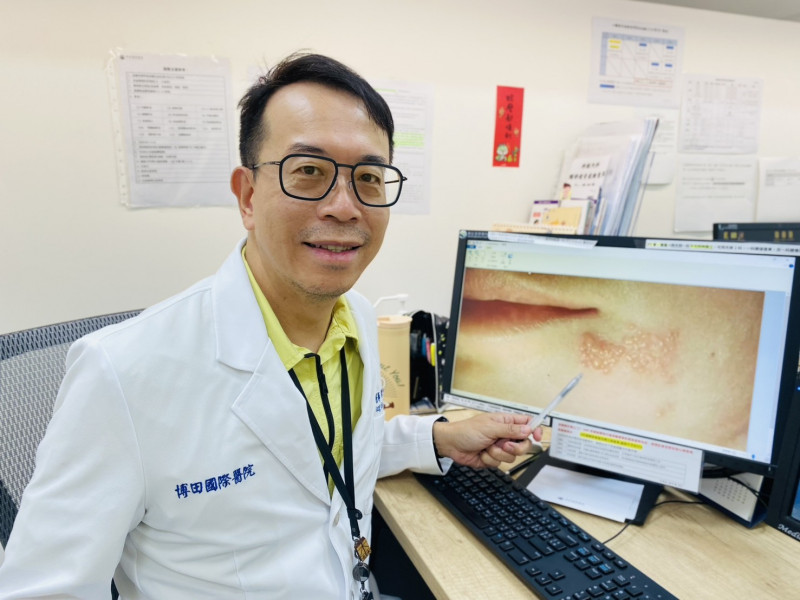 疱疹病毒「住進就不走」 陳琮華醫師提醒：小水疱背後的大麻煩