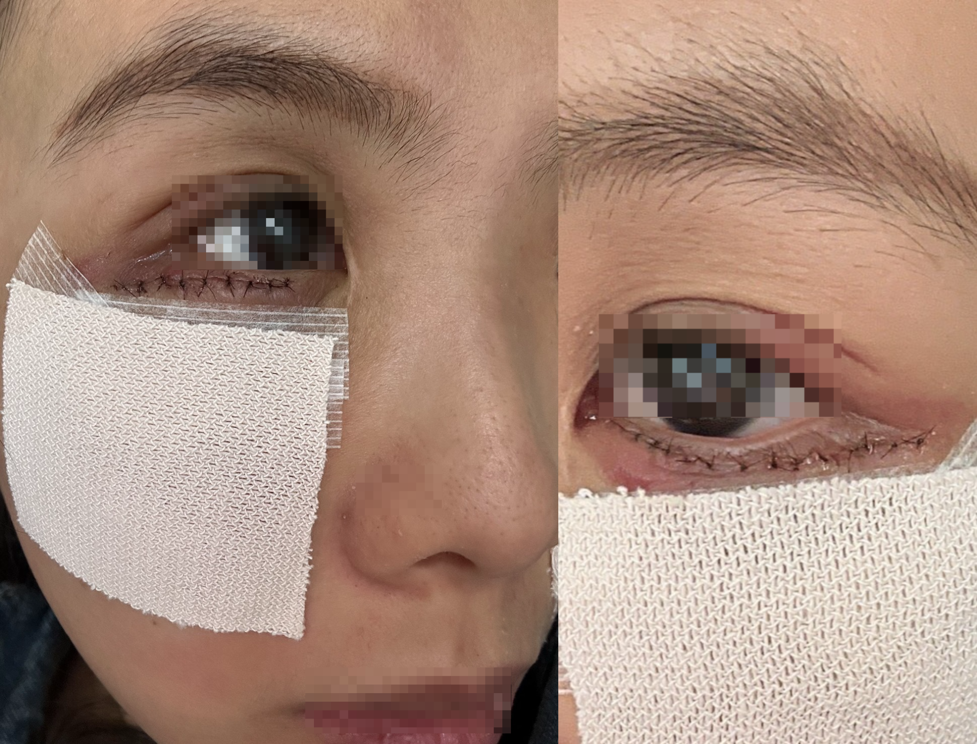 赴上海醫美眼睛出現嚴重後遺症 女子控被逼簽不平等協議 業者反駁不實指控