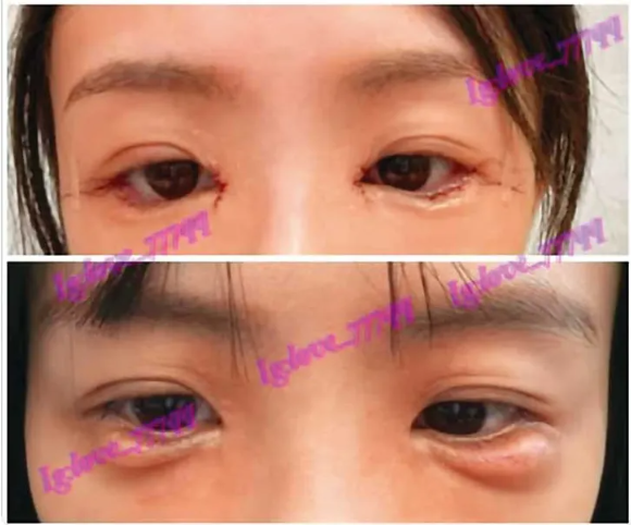 跨境醫美爆黑幕!網紅洪洛妍遭控推銷變洗腦 糾紛、霸凌、卸責全被抓包