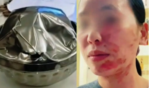 為什麼裝熱油會像丟炸彈？她用錯不鏽鋼碗瞬間爆裂毀容　