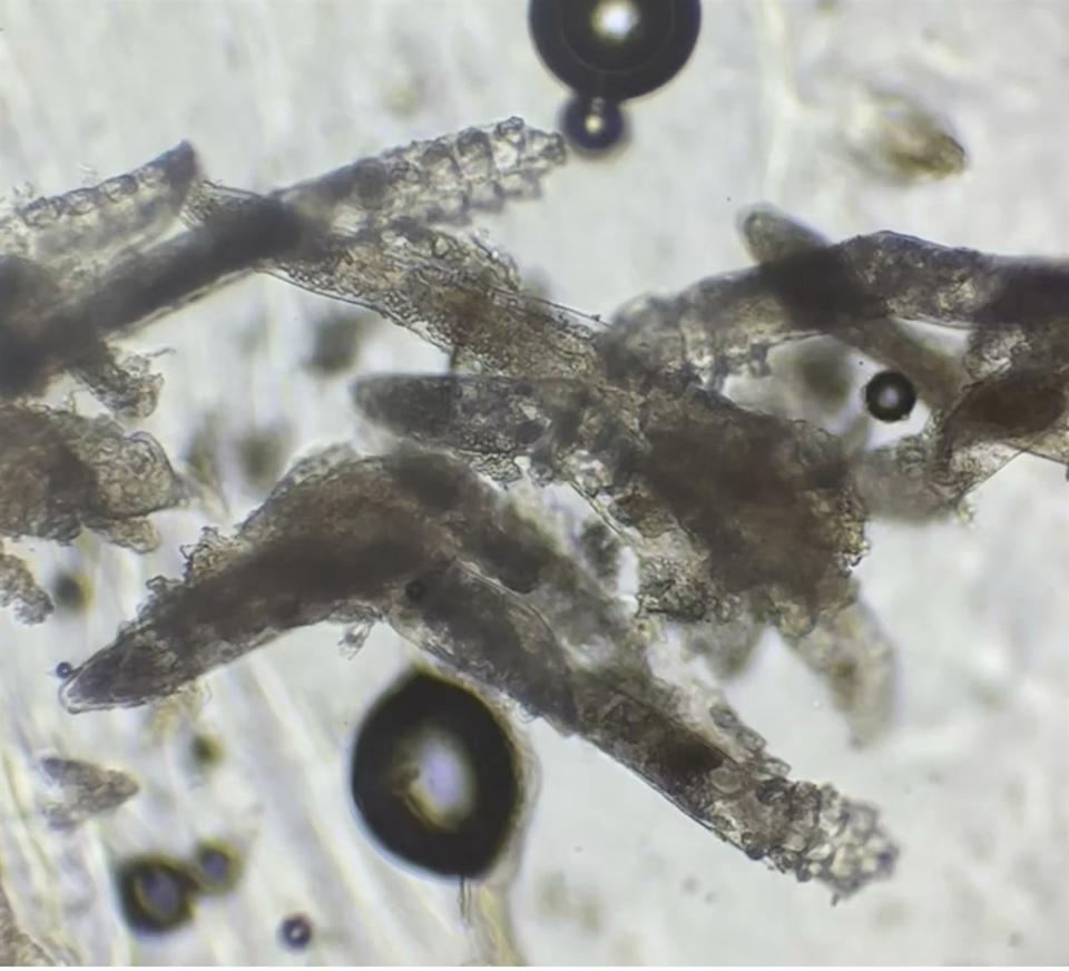 臉上爛痘一年治不好?女大生被診斷「蠕形蟎蟲症」 醫揭:幾乎每個人臉上都有