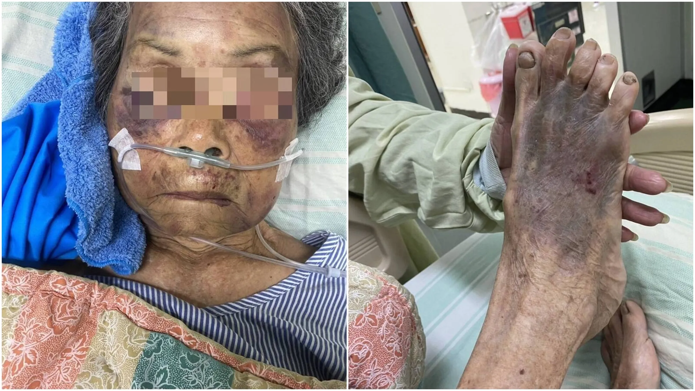 37歲孫子討錢不成竟痛毆90歲阿嬤！腦出血送ICU