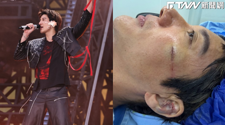 王力宏成都開唱重摔見血！左耳骨碎裂縫27針忍痛上台